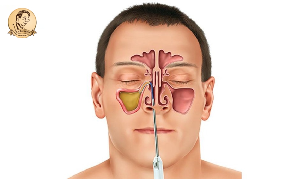Chữa viêm xoang ở Đà Nẵng