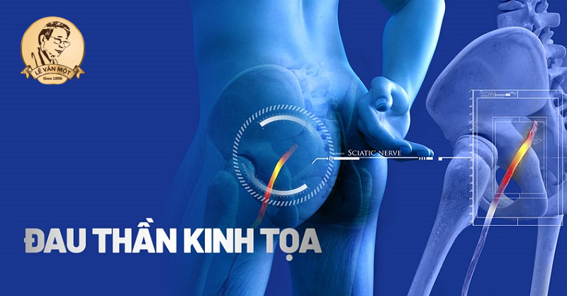 Chữa trị đau thần kinh toạ