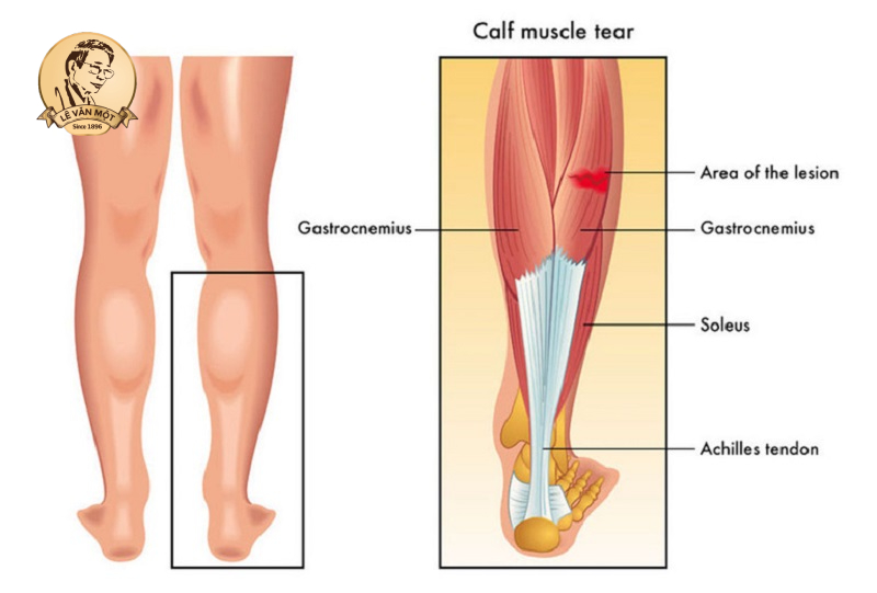Đau căng cơ bắp chân